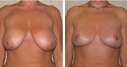 Before & After Photos